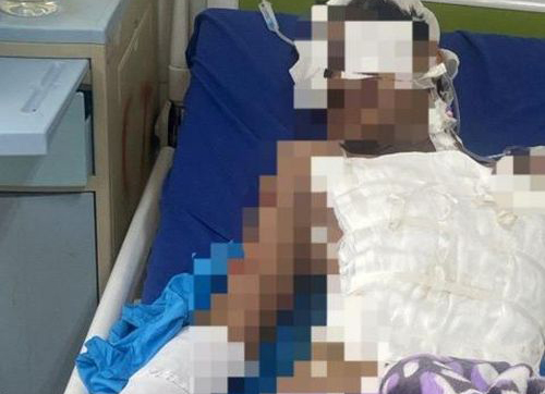  Đắk Nông: Một nam sinh bị thương nặng do tự chế pháo nổ